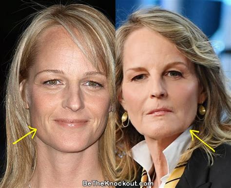 helen hunt surgery|helen hunt before and after.